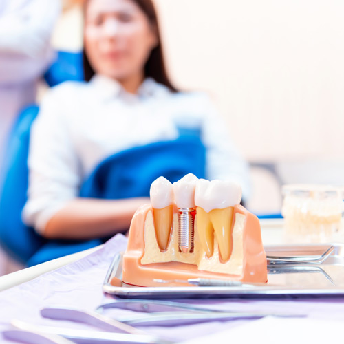 Dental Implants